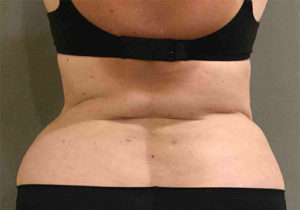 Liposuction Before and After Pictures Bucks County, PA and Hunterdon County, NJ