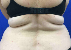 Liposuction Before and After Pictures Bucks County, PA and Hunterdon County, NJ