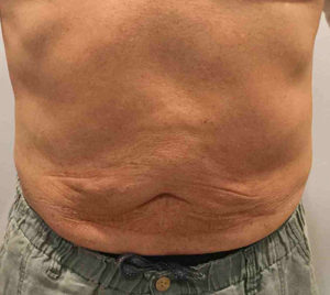 Liposuction Before and After Pictures Bucks County, PA and Hunterdon County, NJ