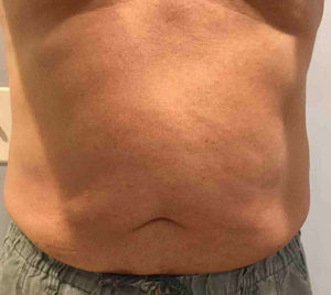 Liposuction Before and After Pictures Bucks County, PA and Hunterdon County, NJ