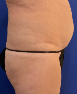 Tummy Tuck Before and After Pictures Bucks County, PA and Hunterdon County, NJ