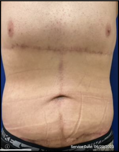 Panniculectomy Before and After Pictures Bucks County, PA and Hunterdon County, NJ