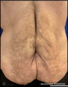 Panniculectomy Before and After Pictures Bucks County, PA and Hunterdon County, NJ