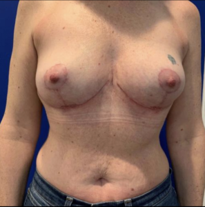Breast Implant Exchange Before and After Pictures Bucks County, PA and Hunterdon County, NJ