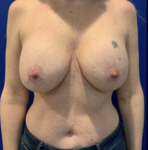 Breast Implant Exchange Before and After Pictures Bucks County, PA and Hunterdon County, NJ