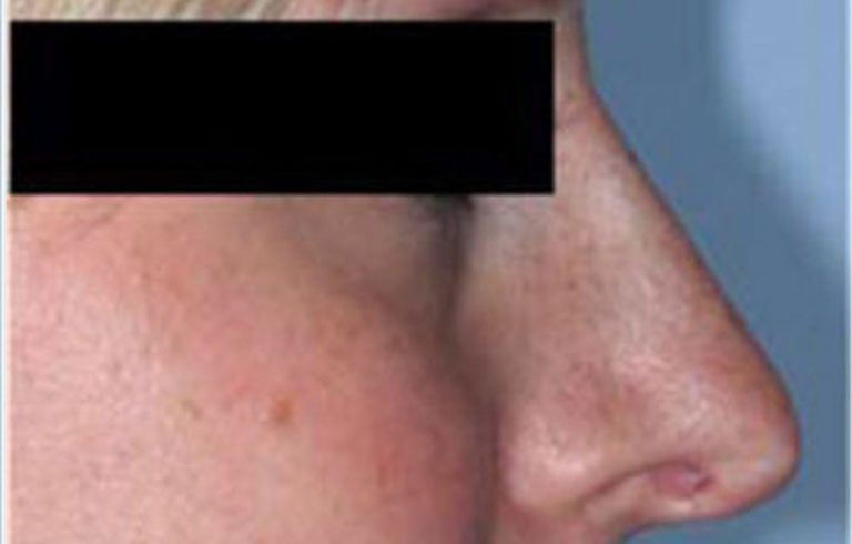 Before and after: rhinoplasty