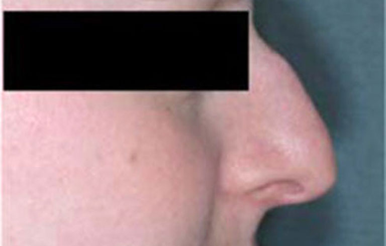 Before and after: rhinoplasty