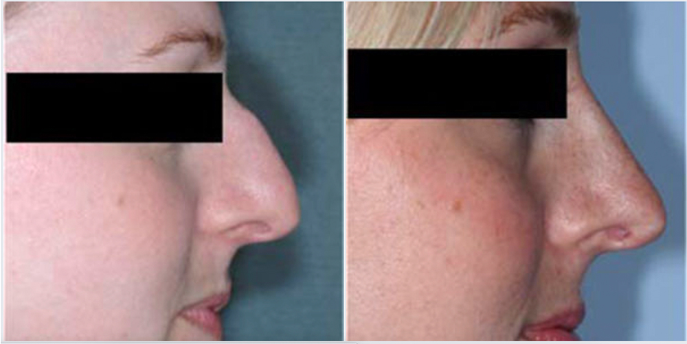 Rhinoplasty Before and After Pictures in Bucks County, PA and Hunterdon County, NJ