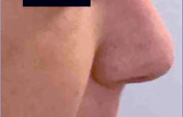 Before and after: rhinoplasty