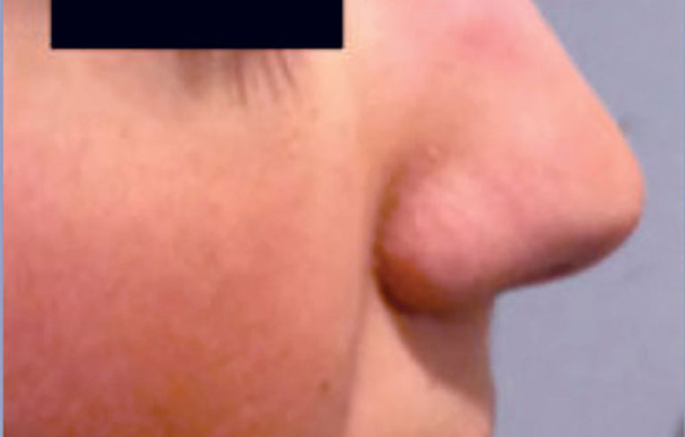Before and after: rhinoplasty