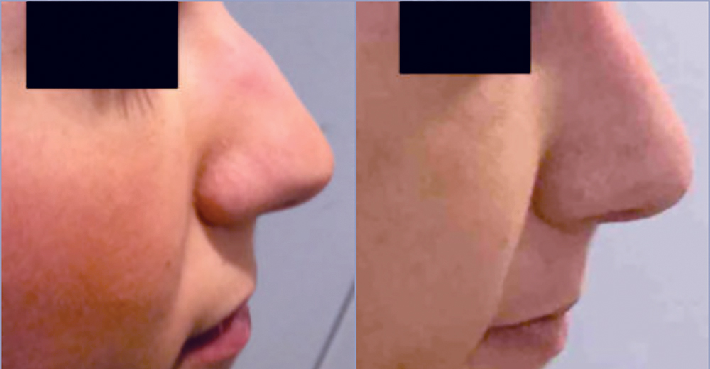 Rhinoplasty Before and After Pictures in Bucks County, PA and Hunterdon County, NJ