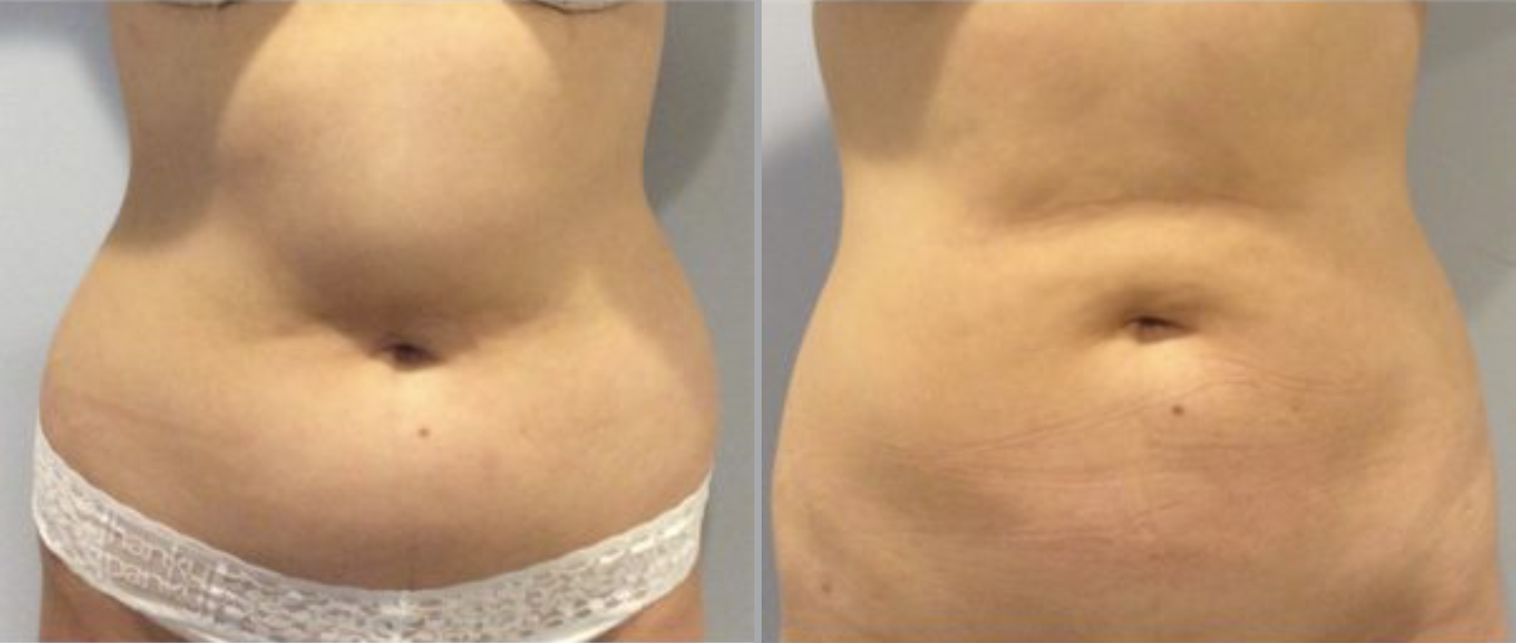 Liposuction Before and After Pictures in Bucks County, PA and Hunterdon County, NJ
