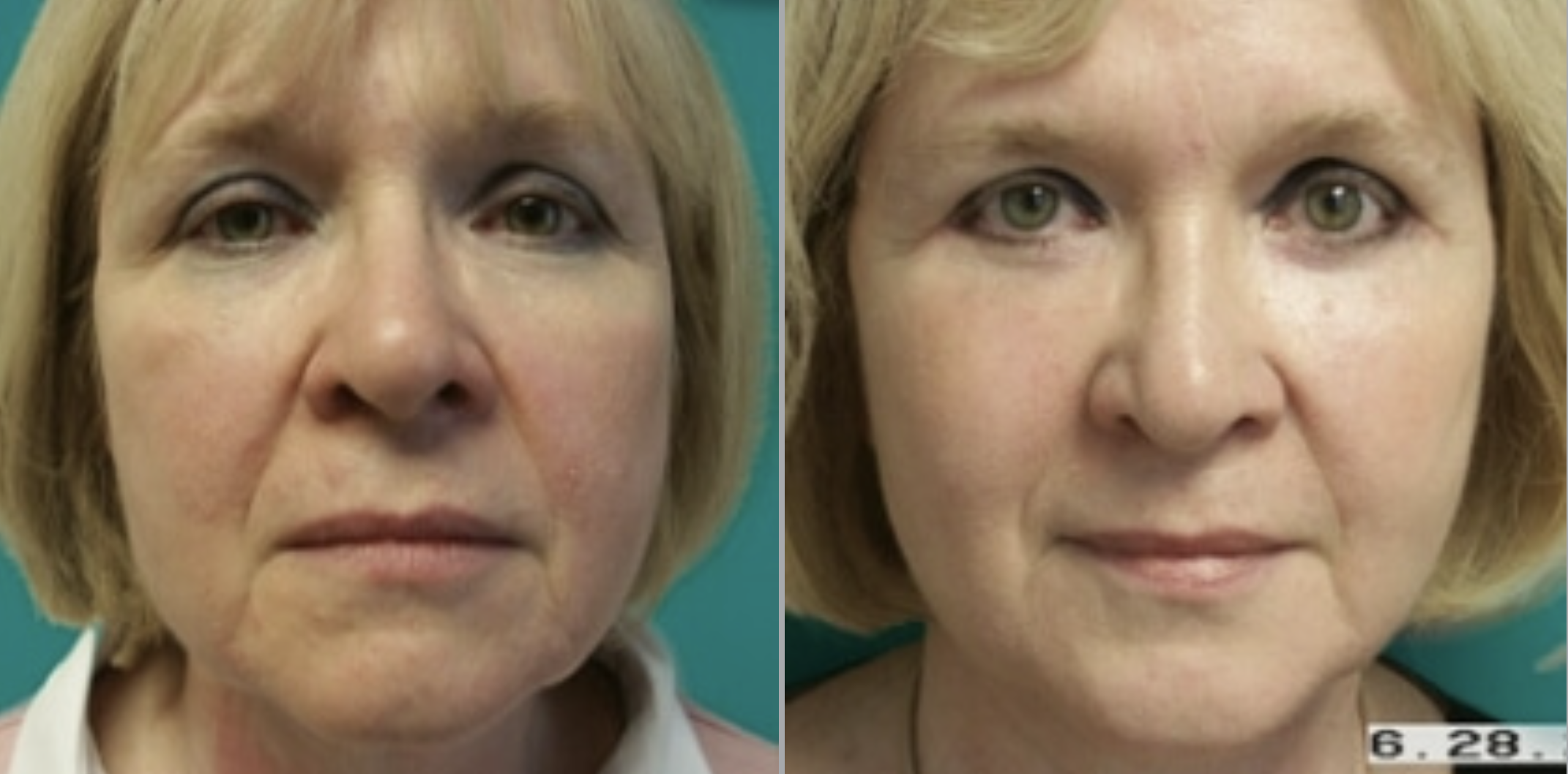 Screen Shot 2023-05-22 at 8.13.20 AM Facelift in Bucks County, PA and Hunterdon County, NJ