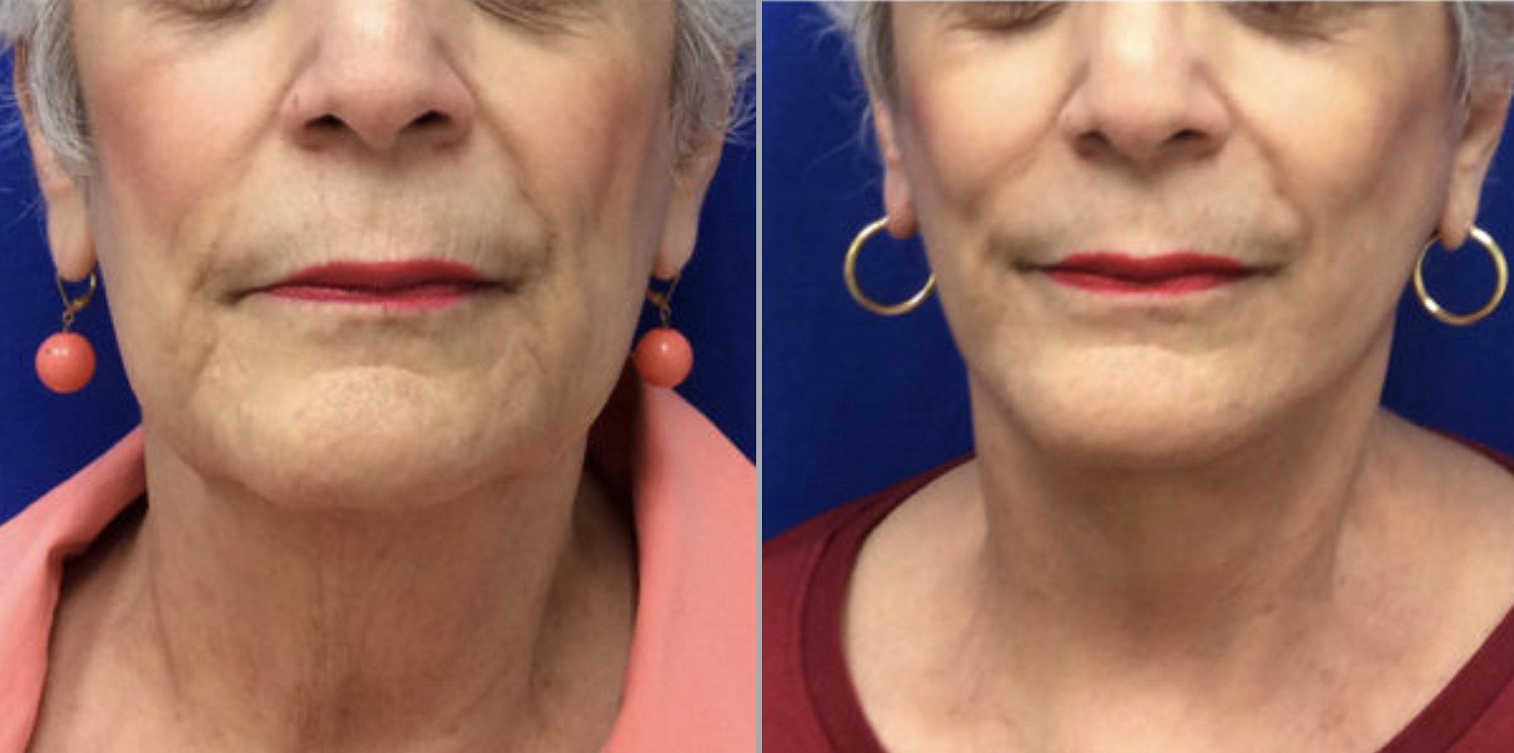 Screen Shot 2023-05-22 at 8.13.29 AM Facelift in Bucks County, PA and Hunterdon County, NJ