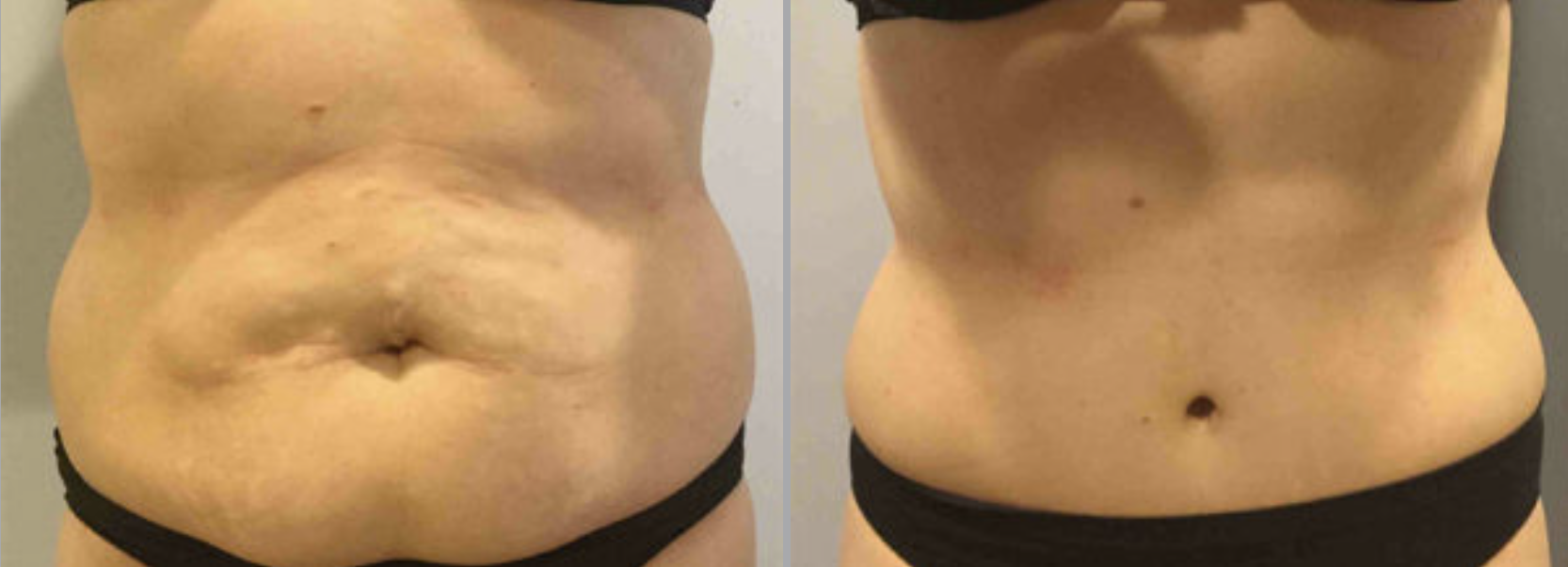 Abdominoplasty Before and After Pictures in Bucks County, PA and Hunterdon County, NJ