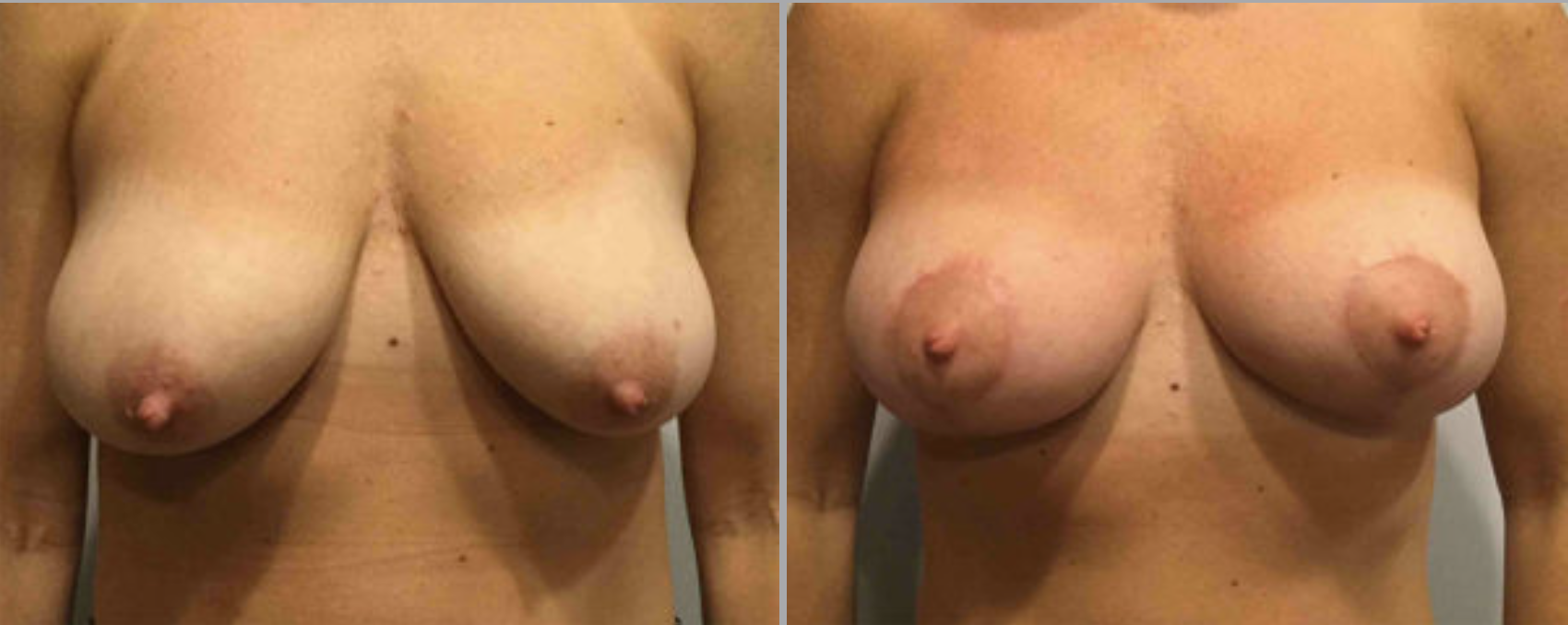 Breast Lift Before and After Pictures in Bucks County, PA and Hunterdon County, NJ