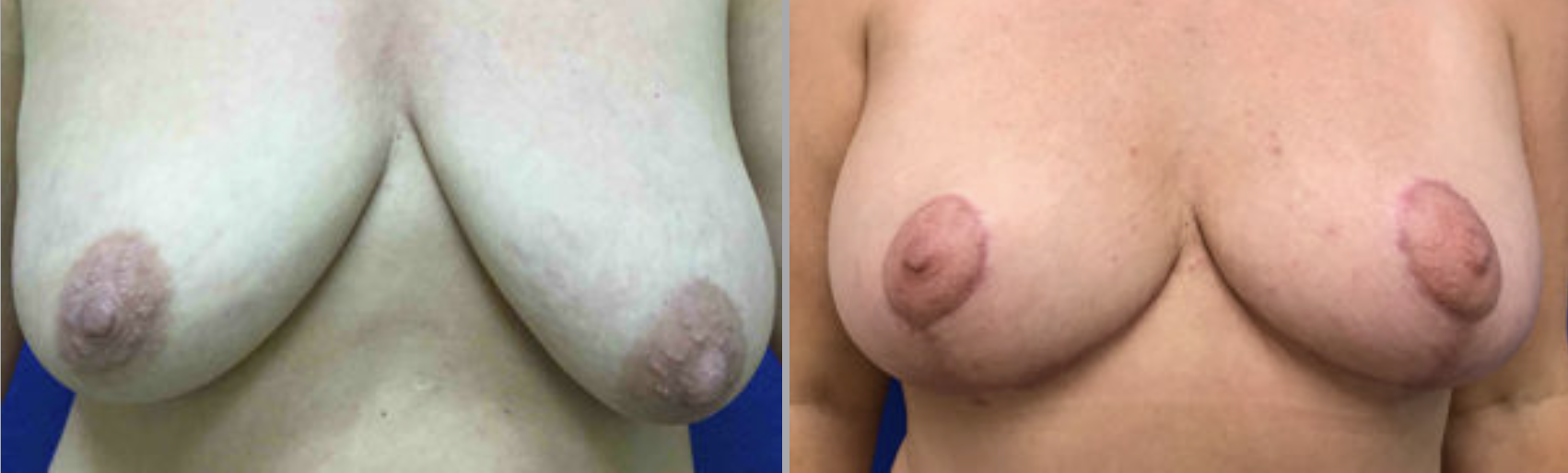 Breast Lift Before and After Pictures Bucks County, PA and Hunterdon County, NJ