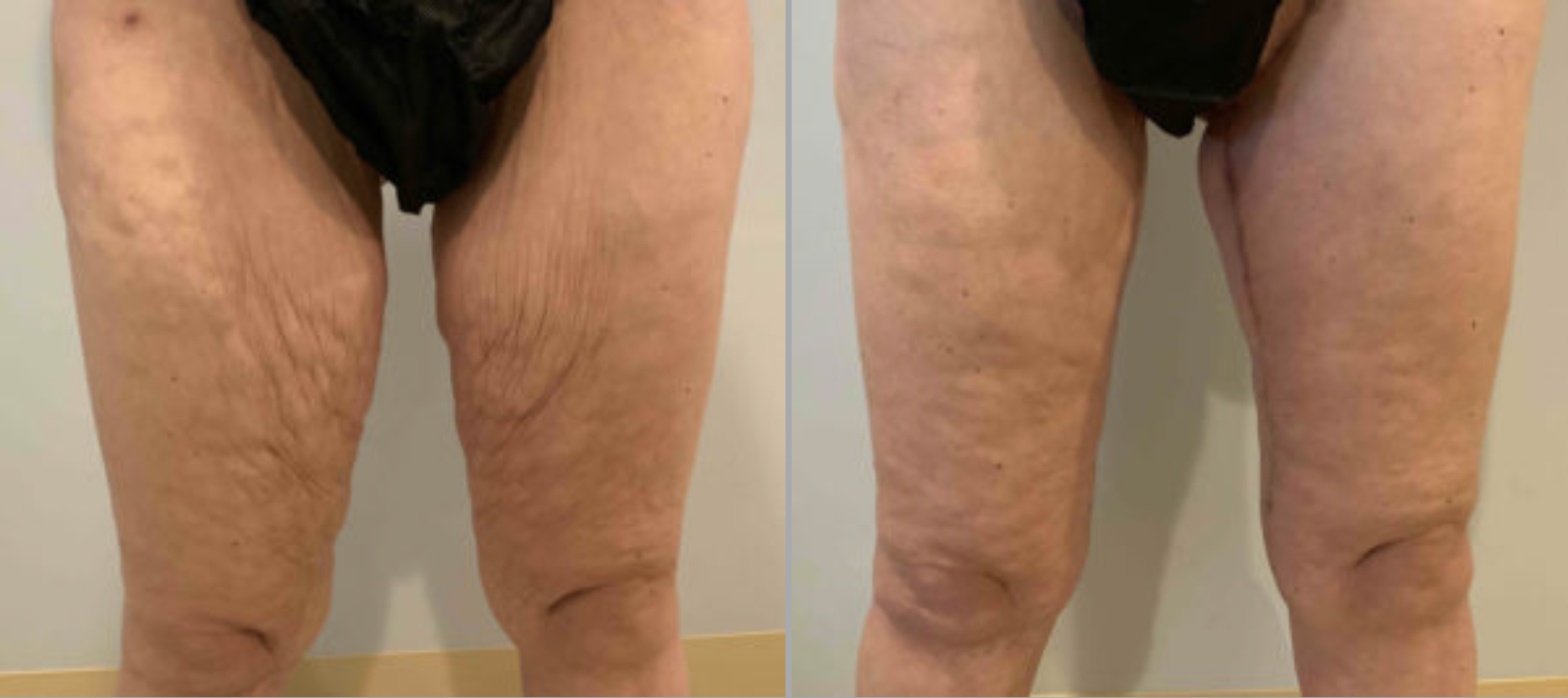 Thigh Lift Before and After Pictures in Bucks County, PA and Hunterdon County, NJ