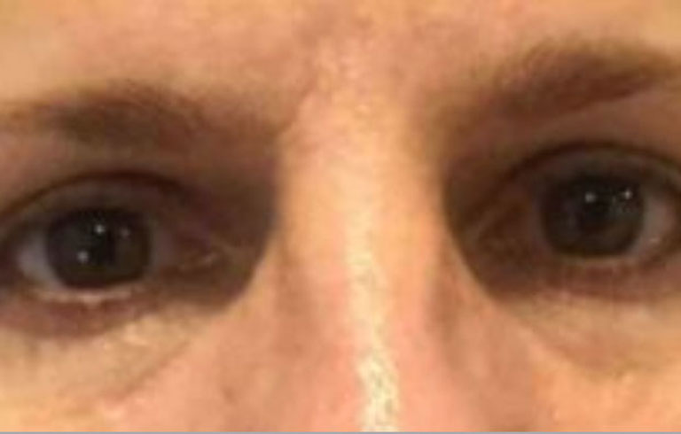 Before and after: blepharoplasty