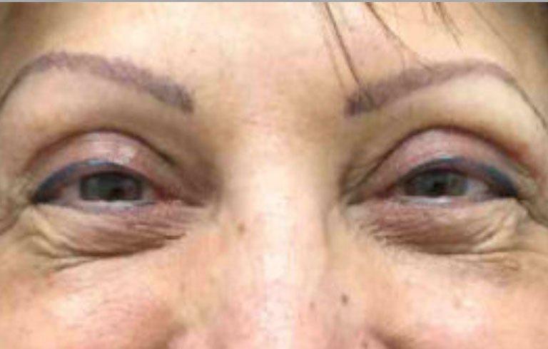 Before and after: blepharoplasty
