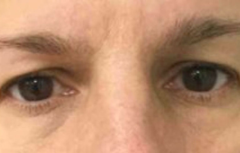 Before and after: blepharoplasty