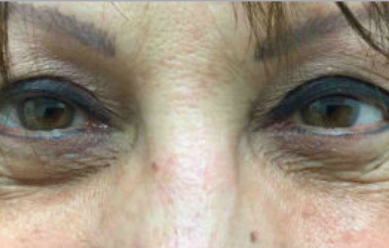 Before and after: blepharoplasty