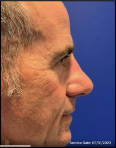 Rhinoplasty Before and After Pictures Bucks County, PA and Hunterdon County, NJ