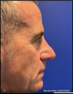 Rhinoplasty Before and After Pictures Bucks County, PA and Hunterdon County, NJ