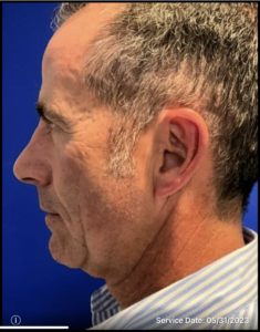 Screenshot-2023-06-07-at-10.51.13-AM-after-235x300 Rhinoplasty Before and After Pictures in Bucks County, PA, and Hunterdon County, NJ