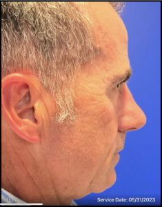 Rhinoplasty Before and After Pictures Bucks County, PA and Hunterdon County, NJ