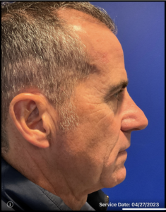 Rhinoplasty Before and After Pictures Bucks County, PA and Hunterdon County, NJ