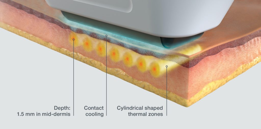 Diagram of Sofwave's ultrasound treatment depth in the skin