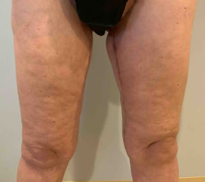 Thigh Lift Before and After Photos in Bucks County, PA, and Hunterdon County, NJ