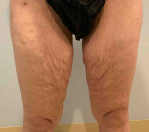 Thigh Lift Before and After Photos in Bucks County, PA, and Hunterdon County, NJ