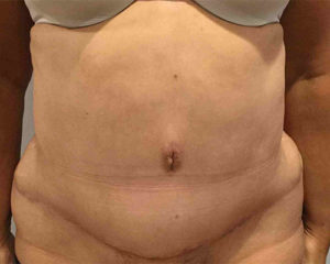 Tummy Tuck Before and After Pictures Bucks County, PA, and Hunterdon County, NJ