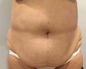 Tummy Tuck Before and After Pictures Bucks County, PA and Hunterdon County, NJ