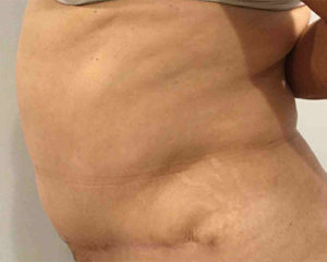 Tummy Tuck Before and After Pictures Bucks County, PA and Hunterdon County, NJ