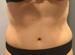 Tummy Tuck Before and After Pictures Bucks County, PA and Hunterdon County, NJ