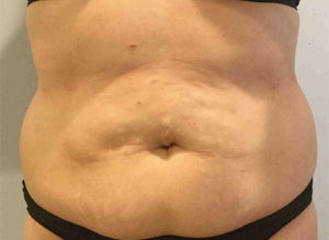 Tummy Tuck Before and After Pictures Bucks County, PA and Hunterdon County, NJ