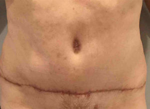 Tummy Tuck Before and After Pictures Bucks County, PA
