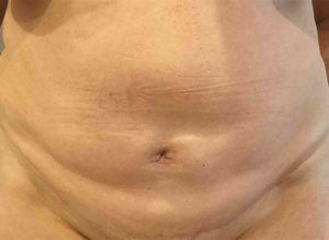 Tummy Tuck Before and After Pictures Bucks County, PA
