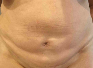 Tummy Tuck Before and After Pictures Bucks County, PA and Hunterdon County, NJ