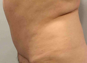 Tummy Tuck Before and After Pictures Bucks County, PA and Hunterdon County, NJ