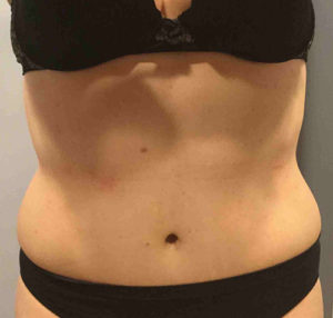 Tummy Tuck Before and After Pictures Bucks County, PA and Hunterdon County, NJ