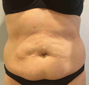 Tummy Tuck in Exton, PA