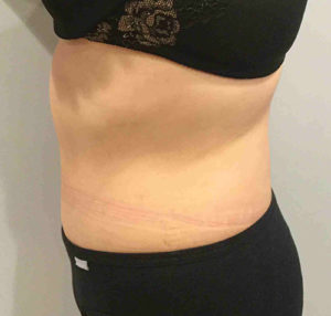 Tummy Tuck Before and After Pictures Bucks County, PA and Hunterdon County, NJ