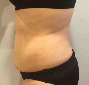 Tummy Tuck Before and After Pictures Bucks County, PA and Hunterdon County, NJ