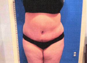 TUMMY TUCK BEFORE AND AFTER IN BUCKS COUNTY, PA, AND HUNTERDON COUNTY, NJ