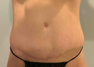 Tummy Tuck Before aTummy Tuck Before and Afternd After