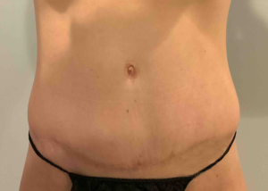 Tummy Tuck Before and After Pictures Bucks County, PA and Hunterdon County, NJ